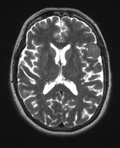 62A3 Meningioma (Case 61) T2 - Copy