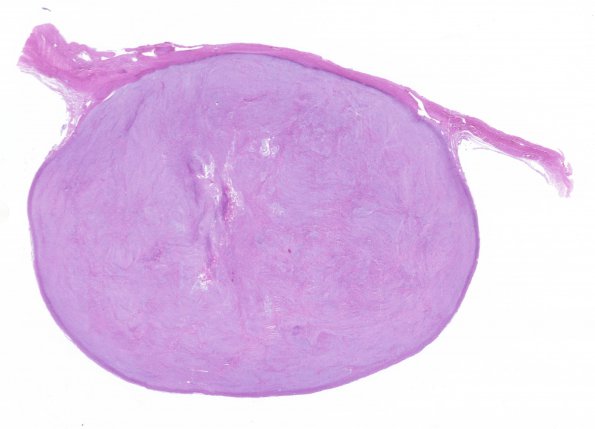 62C1 Meningioma (Case 62) H&E whole mount