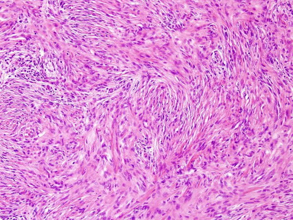 62C2 Meningioma (Case 62) H&E 2.jpg