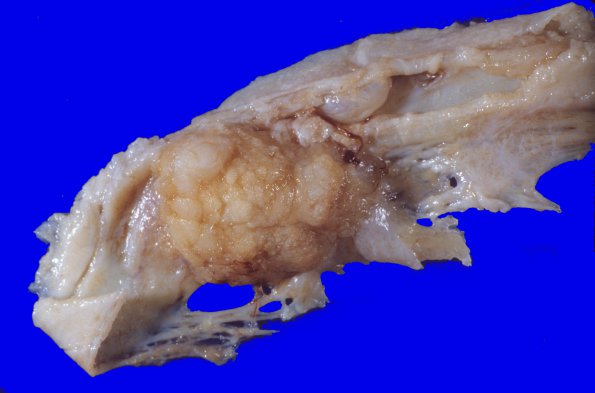 63A Meningioma (WUMS Case) 1