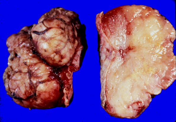 64A Meningioma (WUMS Case) 3