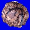 66A Meningioma (WUMS case) gross