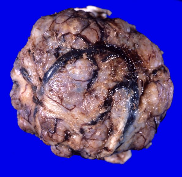 66A Meningioma (WUMS case) gross