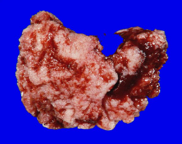 68A Meningioma, Atypical (Case 68) Gross_4