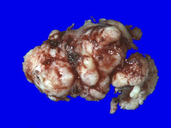 69A1 Meningioma, atypical (Case 69) 1