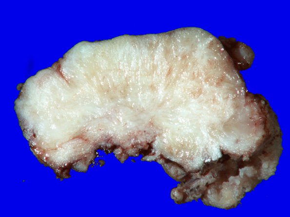 69A2 Meningioma, atypical (Case 69) 5