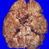 6A1 Meningioma (Case 6) 1