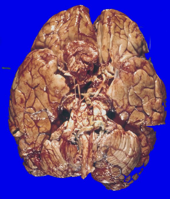 6A1 Meningioma (Case 6) 1