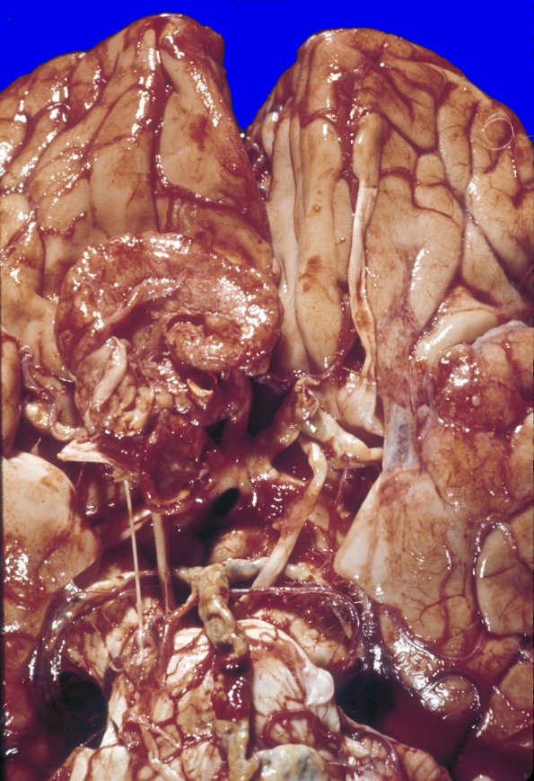 6A2 Meningioma (Case 6)