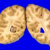 70A1 Meningioma, intraventricular (Case 70) 1