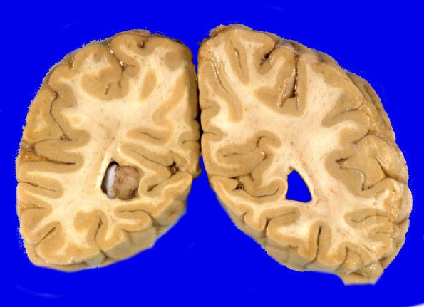 70A1 Meningioma, intraventricular (Case 70) 1