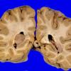 70A2 Meningioma, intraventricular (Case 70) 2