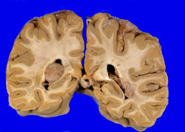 70A2 Meningioma, intraventricular (Case 70) 2