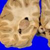 70A3 Meningioma, intraventricular (Case 70) 3