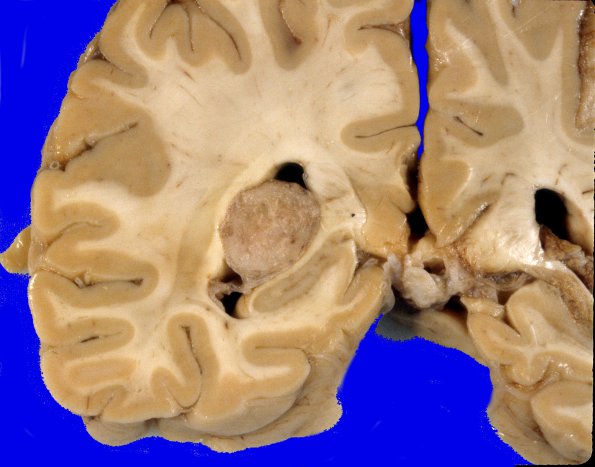 70A3 Meningioma, intraventricular (Case 70) 3