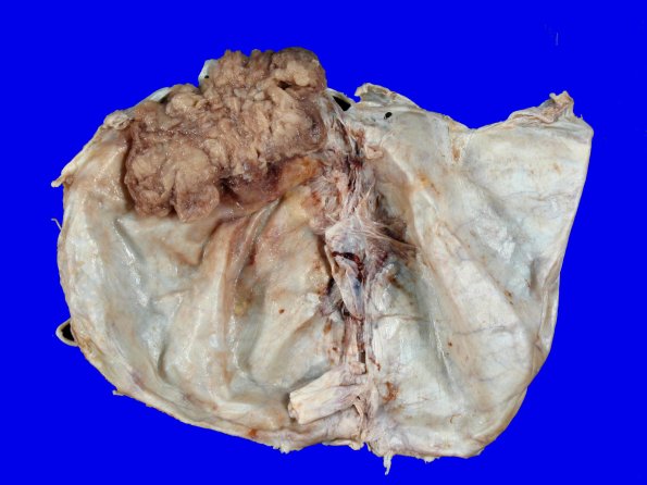 72B1 NCL (Case 72) Gross_4