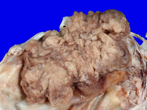 72B2 NCL (Case 72) Gross_5