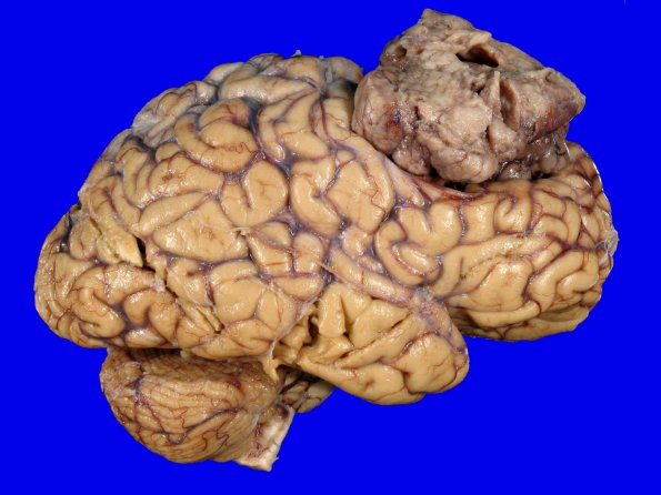 72C1 NCL (Case 72) Gross_6