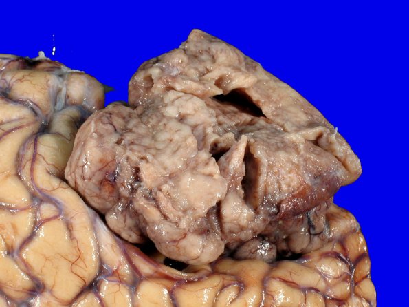 72C2 NCL (Case 72) Gross_10