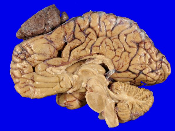 72C3 NCL (Case 72) Gross_8