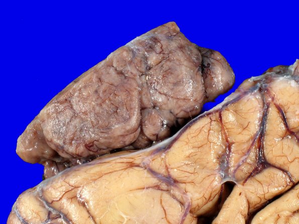 72C4 NCL (Case 72) Gross_9