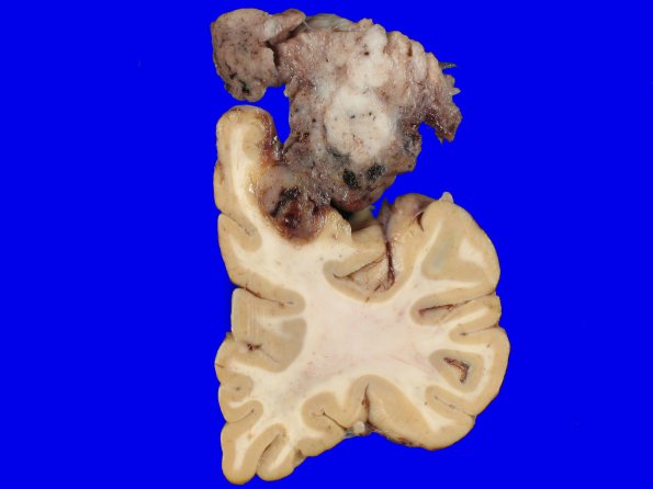 72D2 NCL (Case 72) Gross_12