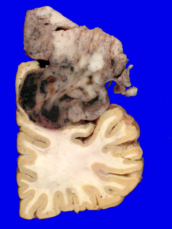 72D3 NCL (Case 72) Gross_14