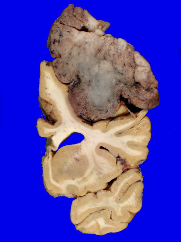 72D6 NCL (Case 72) Gross_16