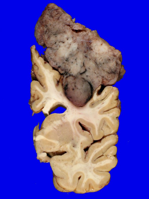 72D7 NCL (Case 72) Gross_17