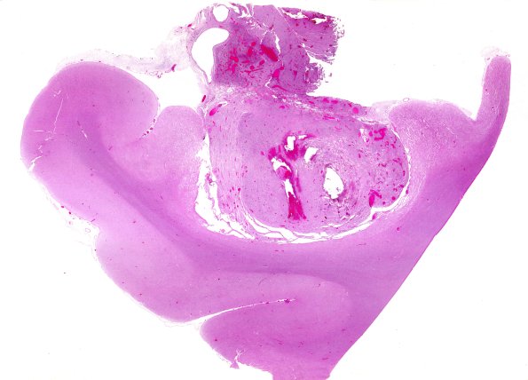 72E1 NCL (Case 72) H&E WM