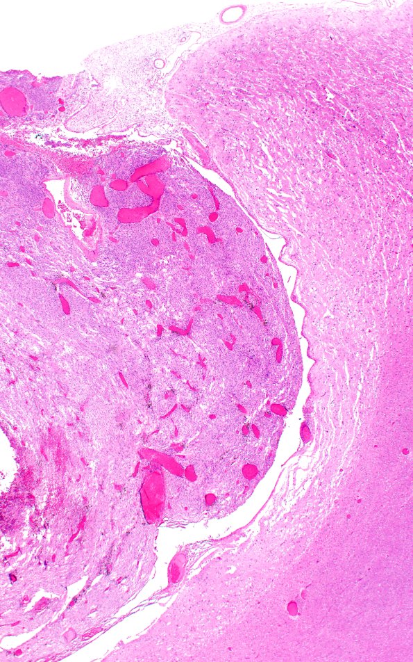 72E2 NCL (Case 72) H&E 2X