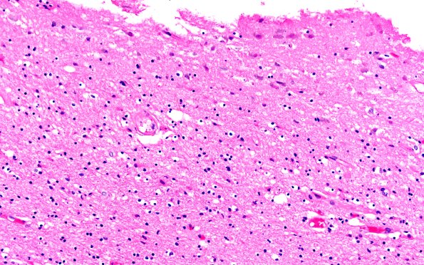 72E5 NCL (Case 72) H&E 20X