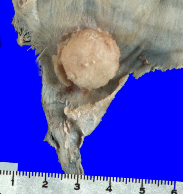 7A1 Meningioma (Case 7) Gross_1