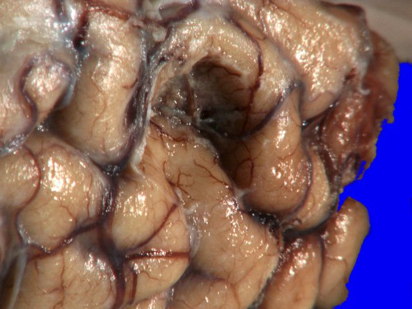 7A2 Meningioma (Case 7) Gross_2