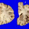 7A3 Meningioma (Case 7) Gross_3 copy