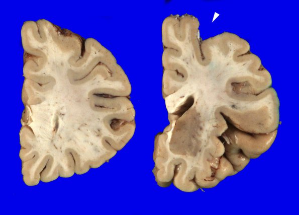 7A3 Meningioma (Case 7) Gross_3 copy