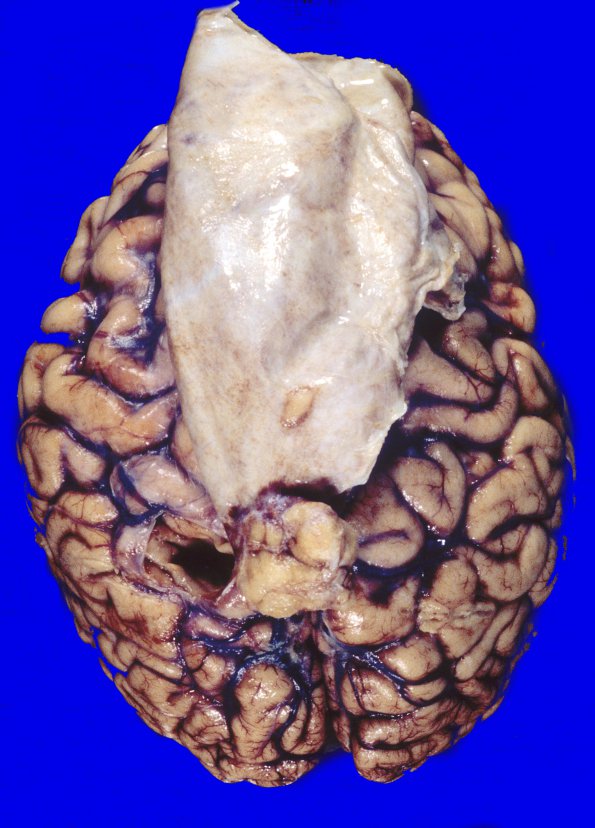 8A1 Meningioma (Case 8) 6