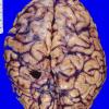 8A2 Meningioma (Case 8) 1