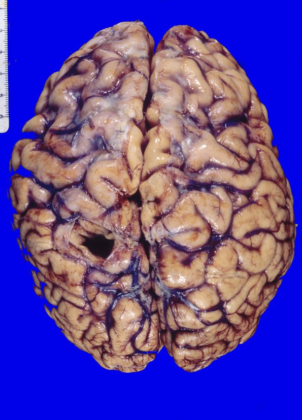 8A2 Meningioma (Case 8) 1