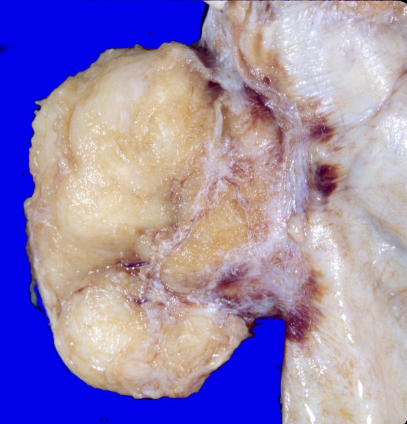 8A3 Meningioma (Case 8) 3