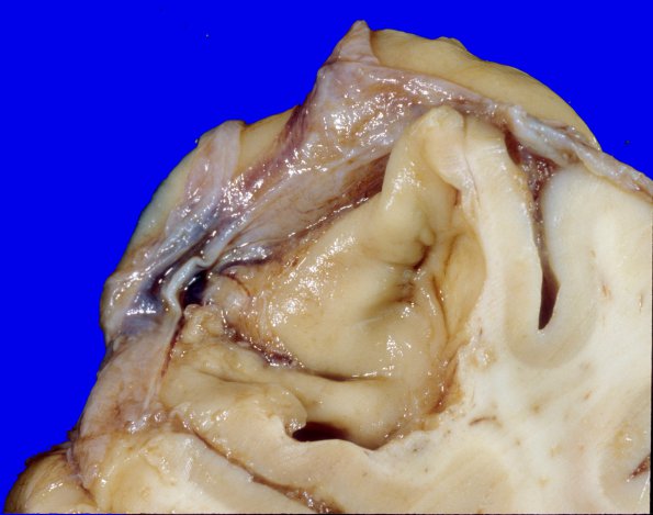 8A5 Meningioma (Case 8) 2