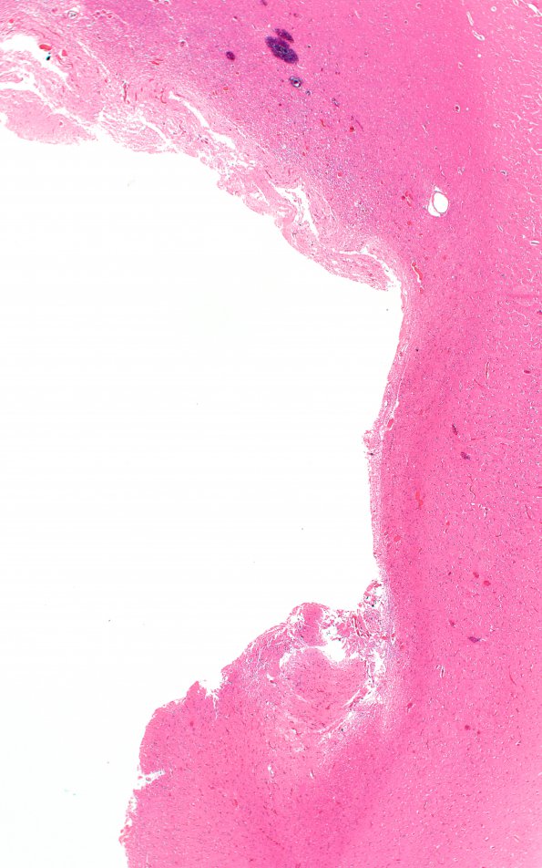 8B2 Meningioma (Case 8) H&E 2X