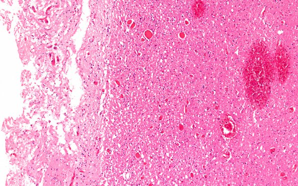 8B3 Meningioma (Case 8) H&E 10X