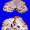 9A1 Meningioma (Case 9) 2