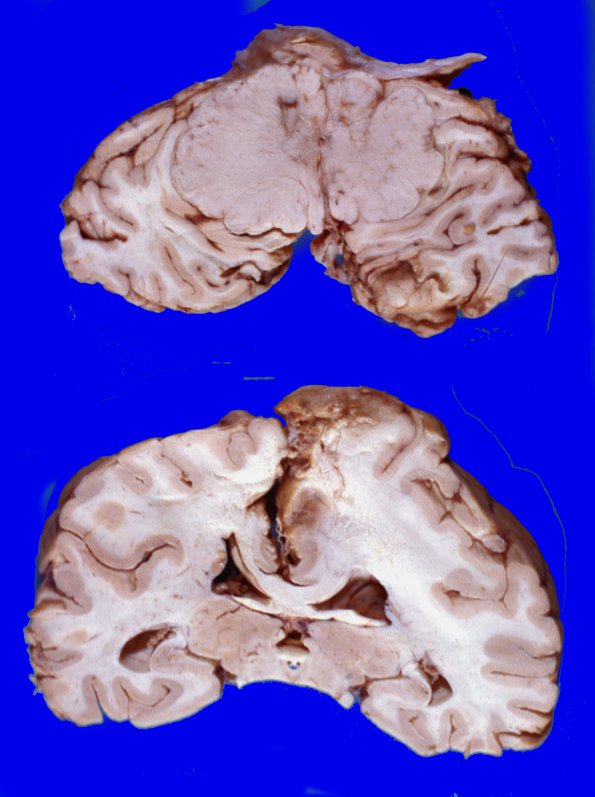 9A1 Meningioma (Case 9) 2