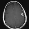 1A3 Meningioma, atypical, lymphoplasmacytic type (Case 1) T1W - Copy