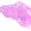 1B1 Meningioma, lymphoplasmacytic (Case 1) A3 H&E WM