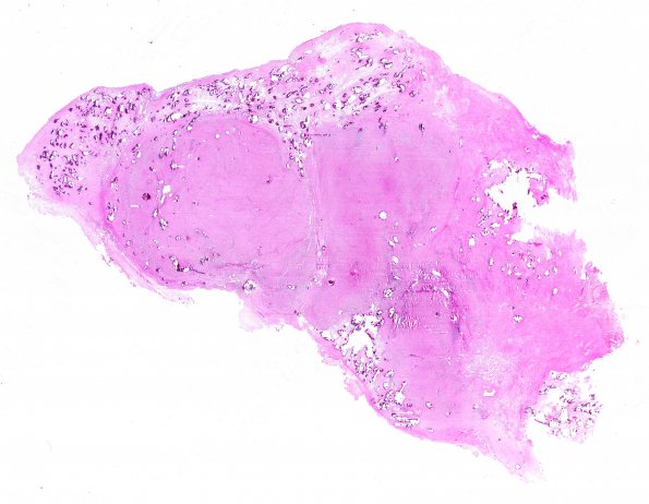 1B1 Meningioma, lymphoplasmacytic (Case 1) A3 H&E WM