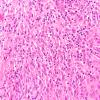1B10 Meningioma, atypical, lymphoplasmacytic type (Case 1) A4 H&E 40X 2