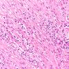 1B12 Meningioma, atypical, lymphoplasmacytic type (Case 1) A4 H&E 40X 5